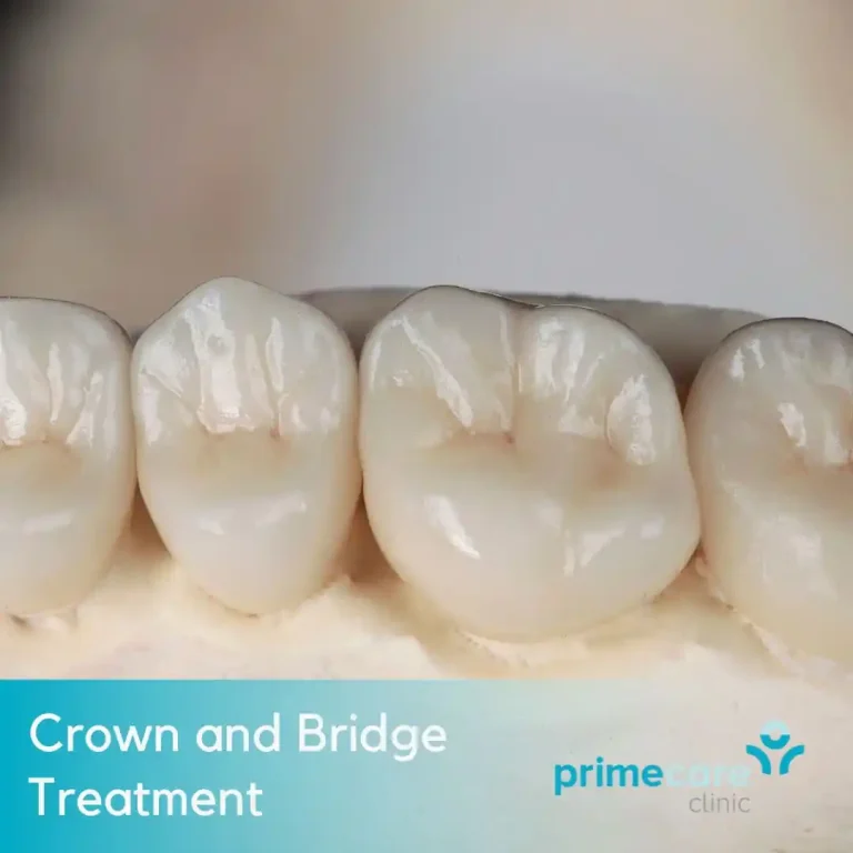 Crown and Bridge Treatment