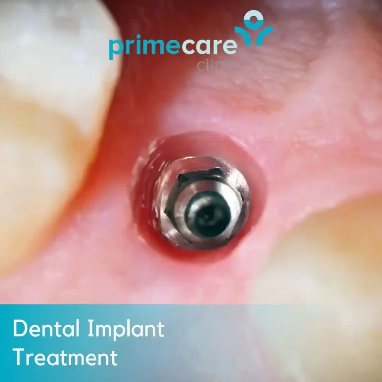 Dental Implant Treatment