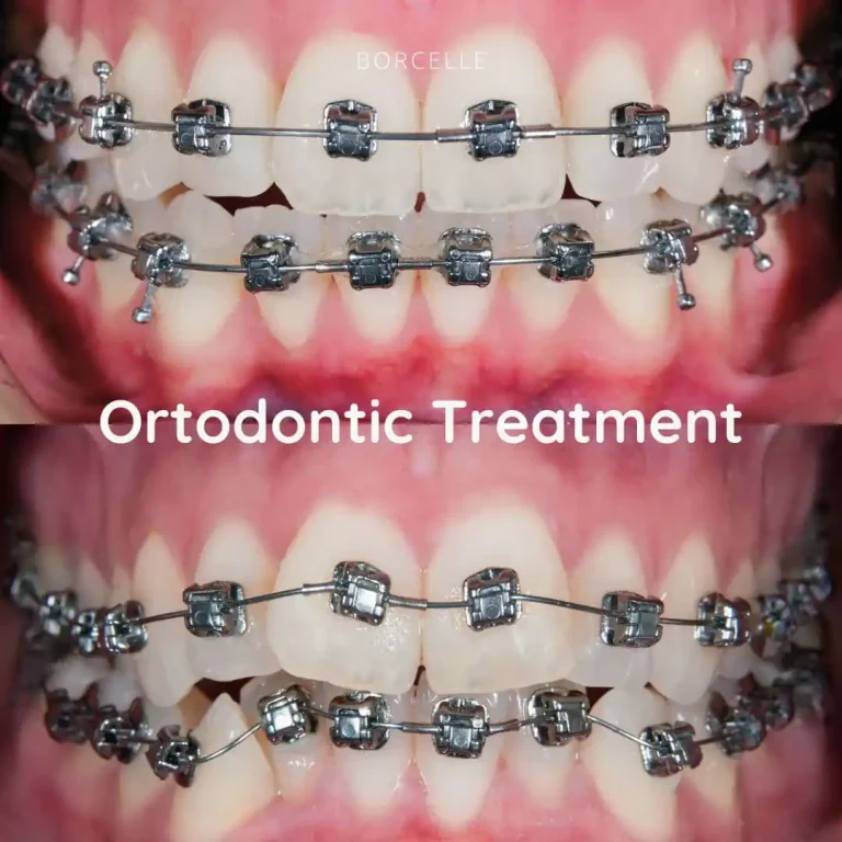 Ortodontic Treatment