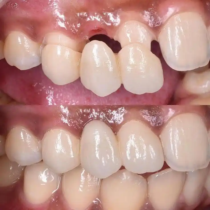 dental bridge
