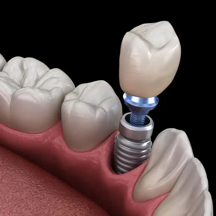 dental implant