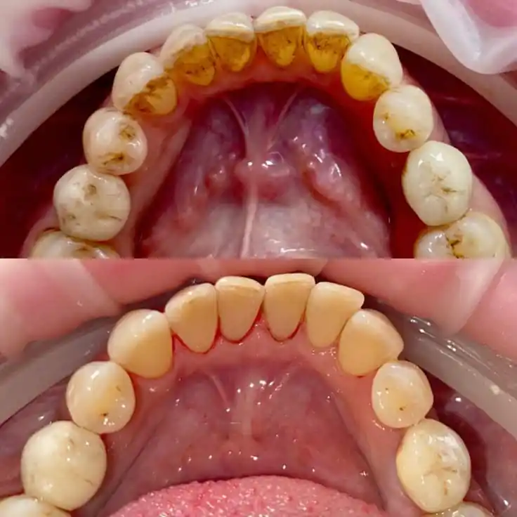 scalling before after